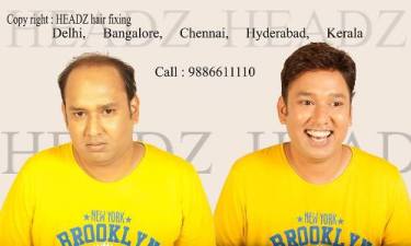 Headz Hair Fixing Cost Non Surgical Hair Replacement cost