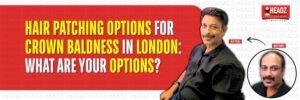 Hair Patching options for Crown Baldness in London